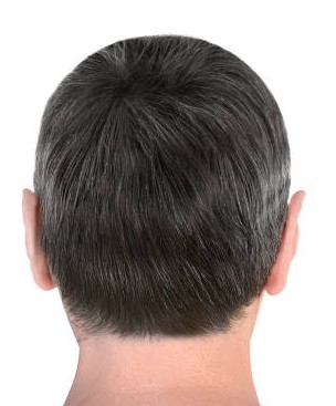 After hair transplant