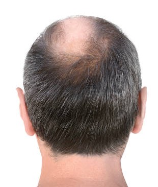 Before hair transplant