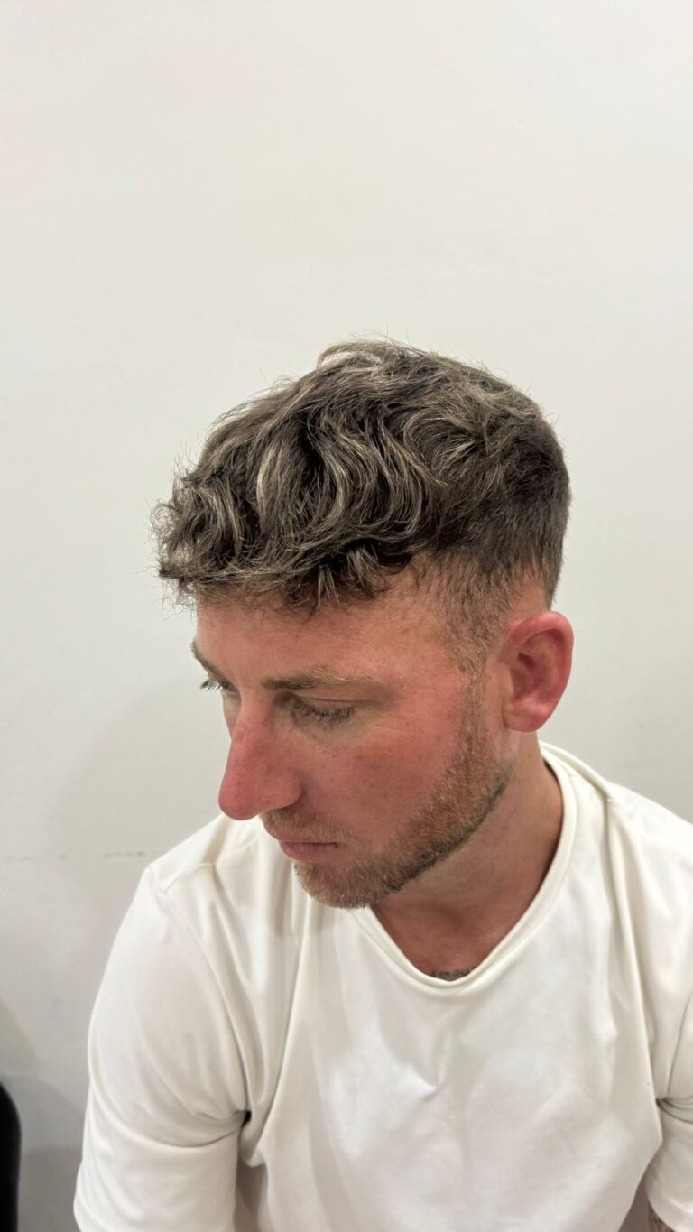 After — FUE Sapphire Hair Transplant