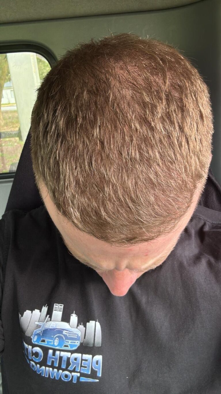 After — DHI Hair Transplant