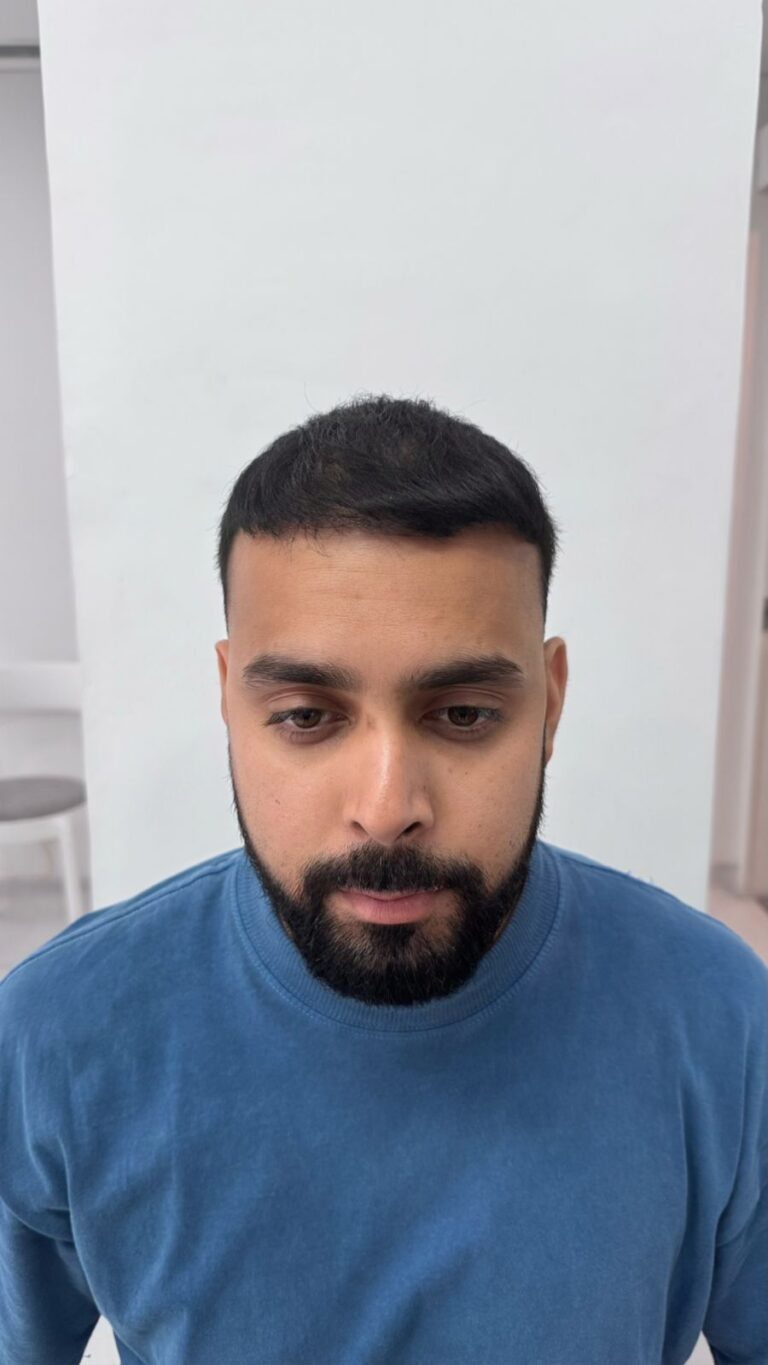 After — Direct Hair Implantation (DHI)