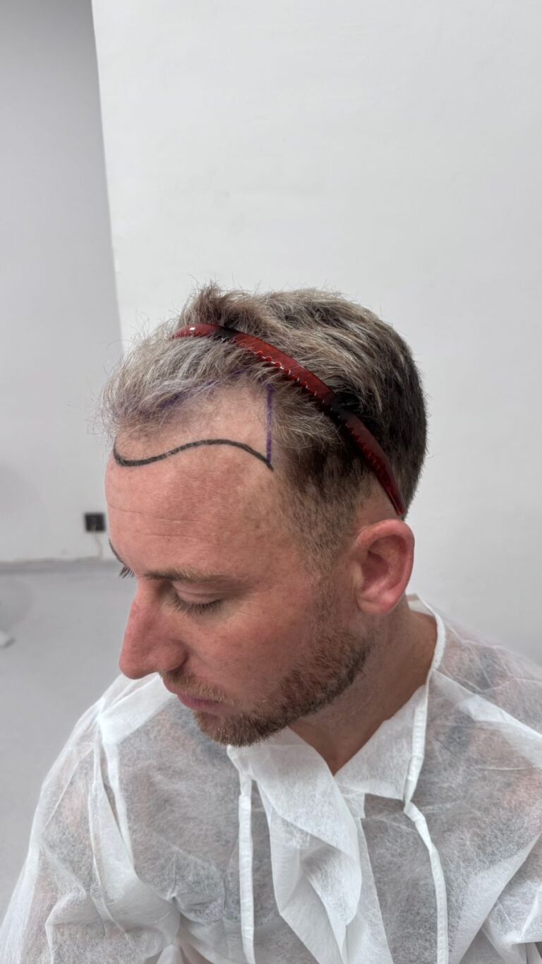 Before — FUE Sapphire Hair Transplant