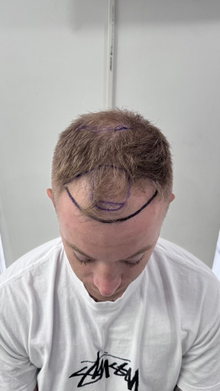 Before — DHI Hair Transplant