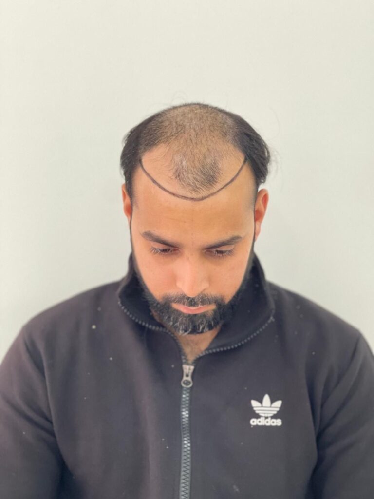 Before — Direct Hair Implantation (DHI)