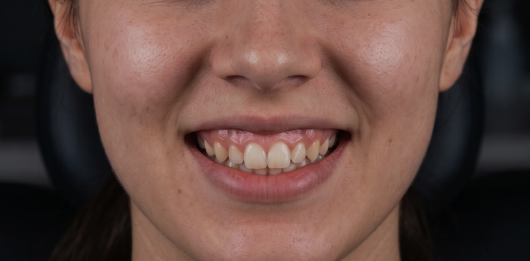 Before treatment