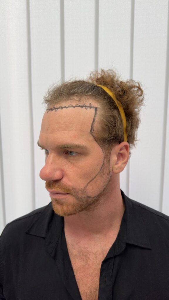 Before hair transplant