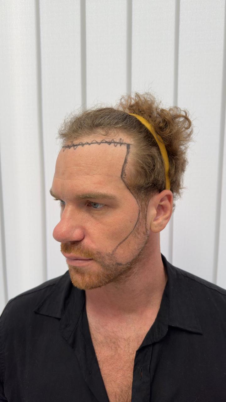 Before — Hairline Redesign