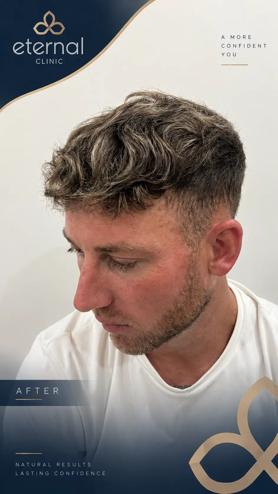 After hair transplant