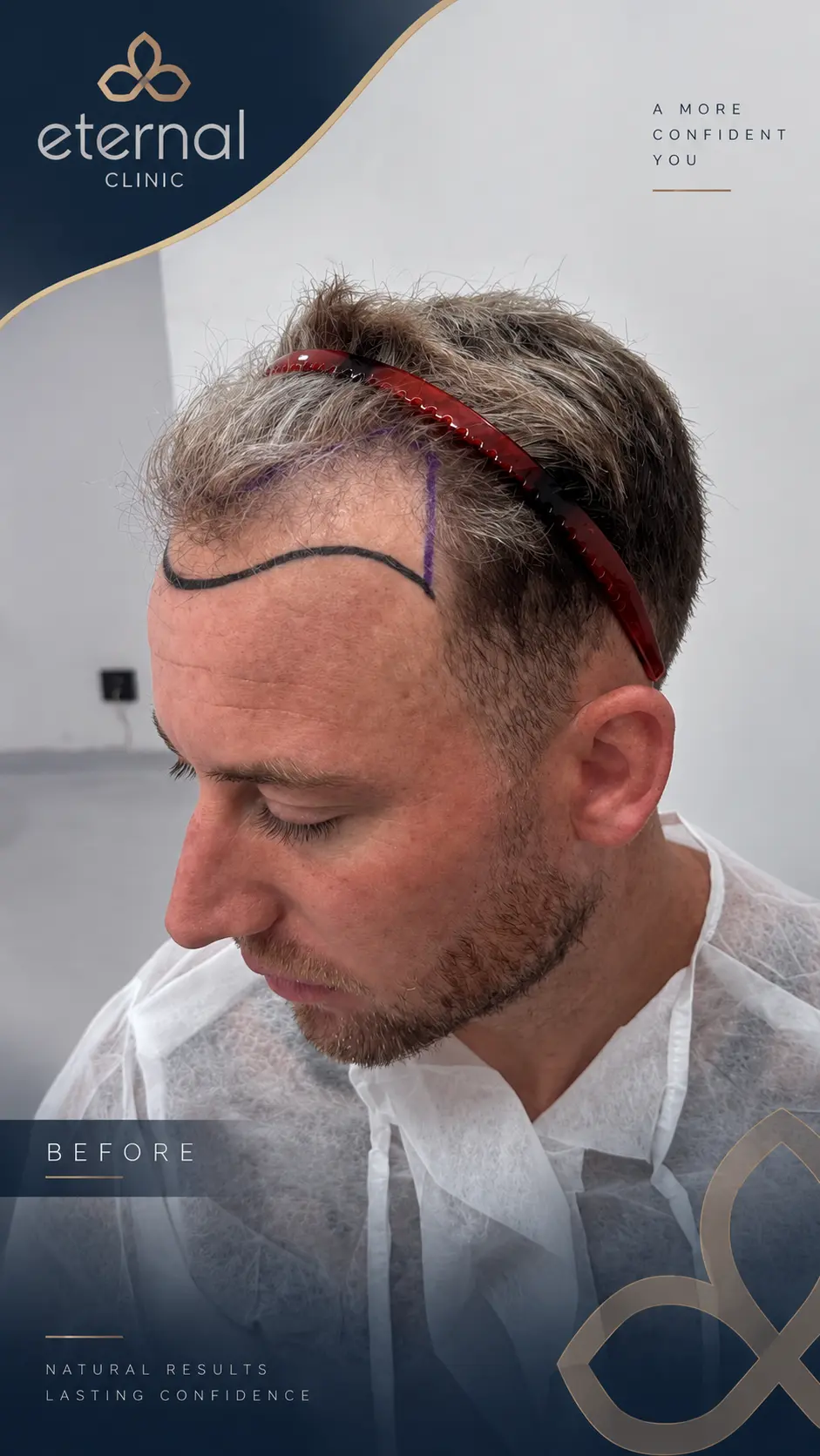 Before hair transplant
